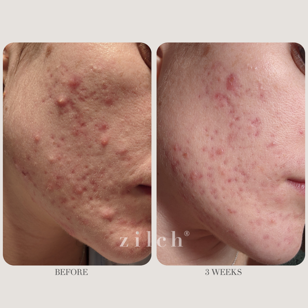 Zilch Acne Formula Before and After photo review