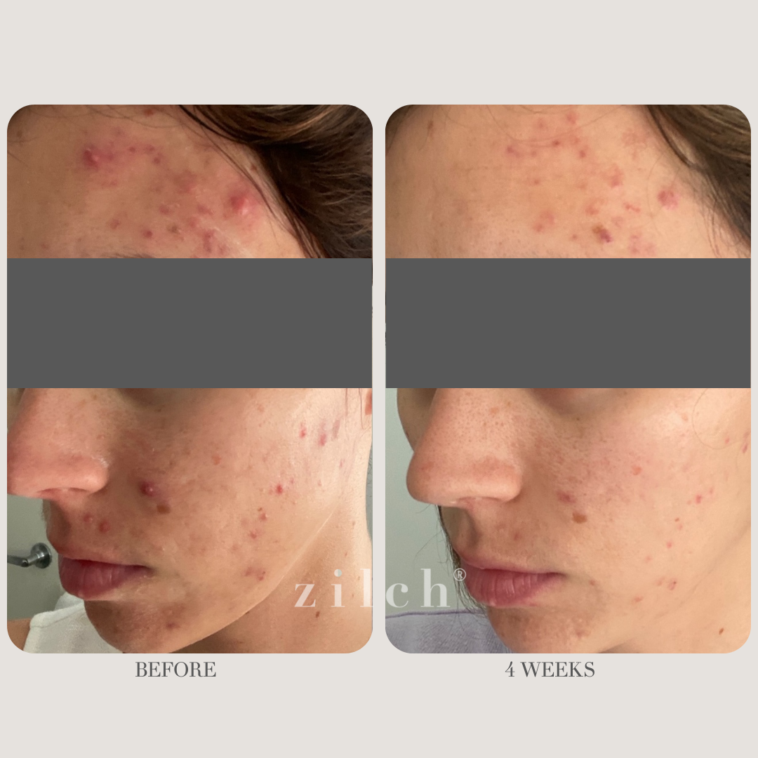 Zilch Acne Formula Before and After photo review