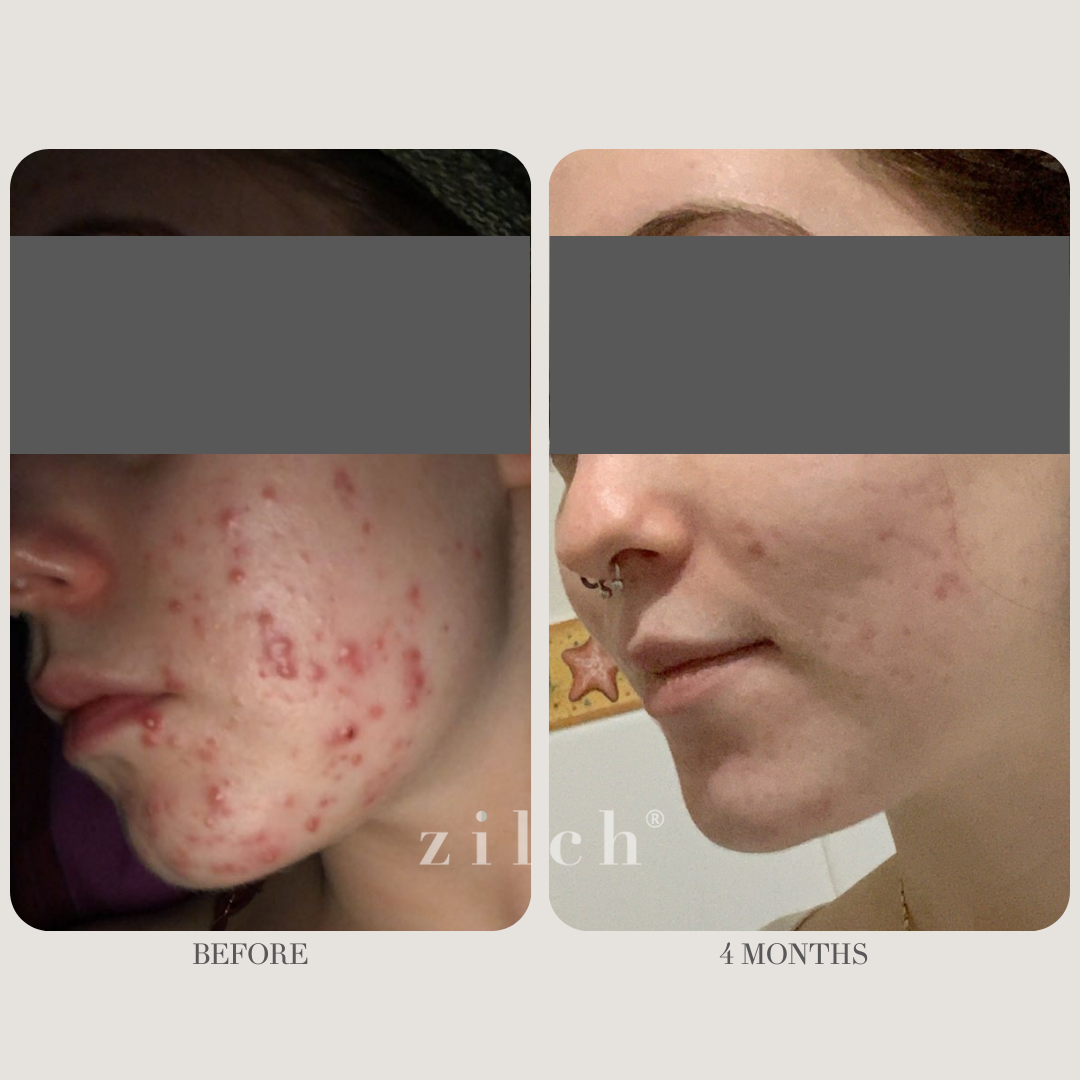 Zilch Acne Formula Before and After photo review