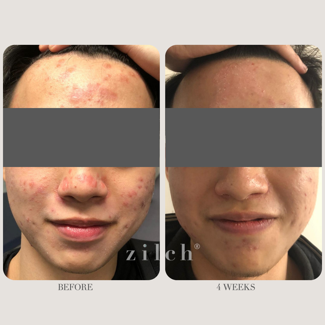 Zilch Acne Formula Before and After photo review