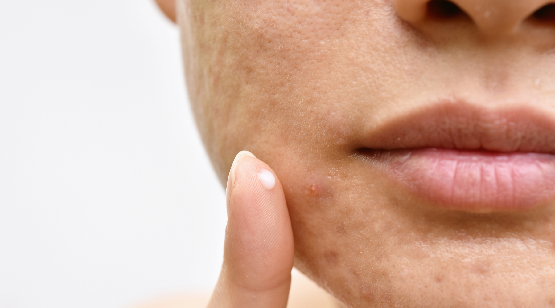 Understanding Body Acne and Face Acne Through Chinese Medicine