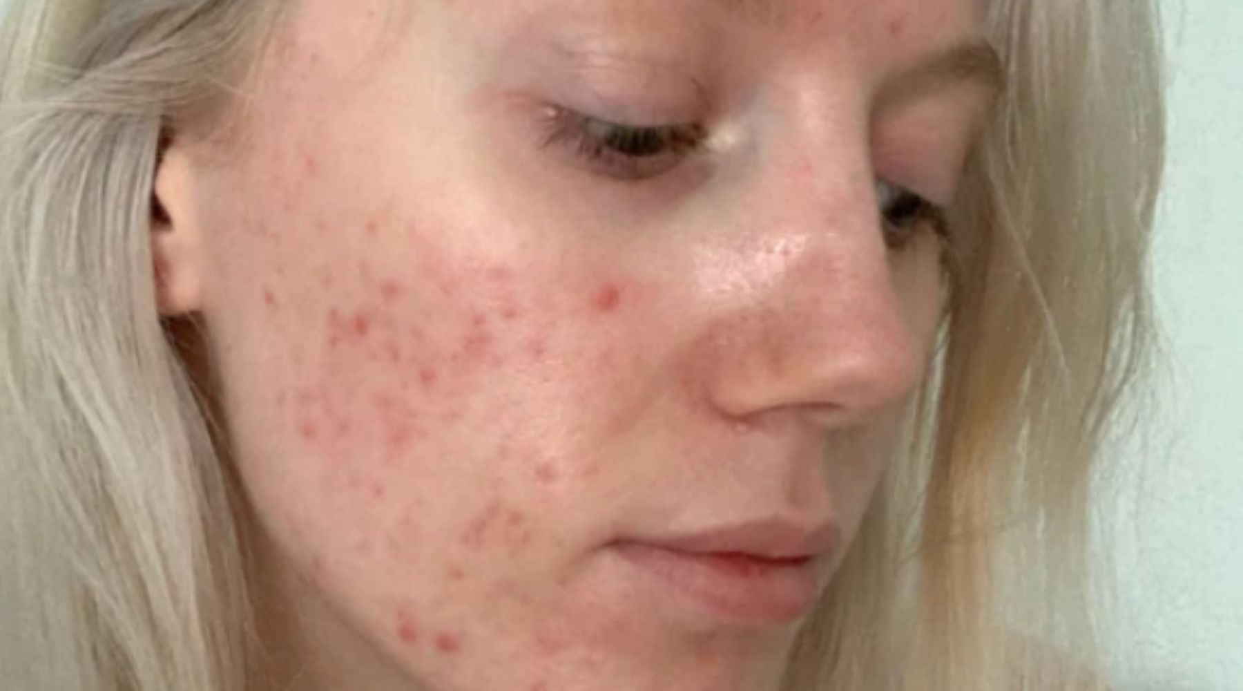 Different types of acne–explained.