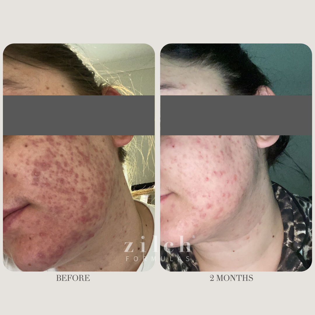Zilch Acne Formula Before and After photo review