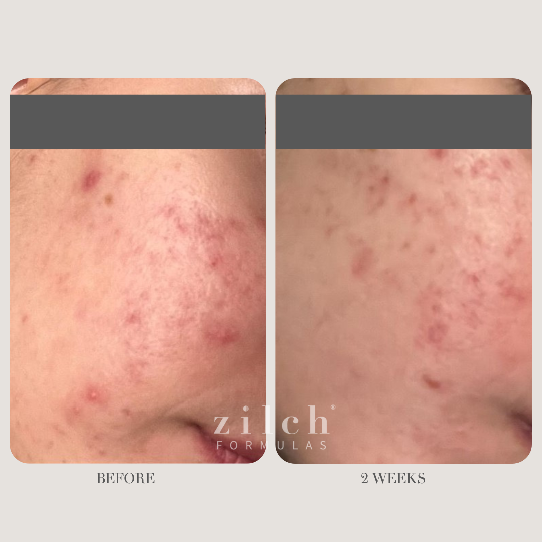 Zilch Acne Formula Before and After photo review 