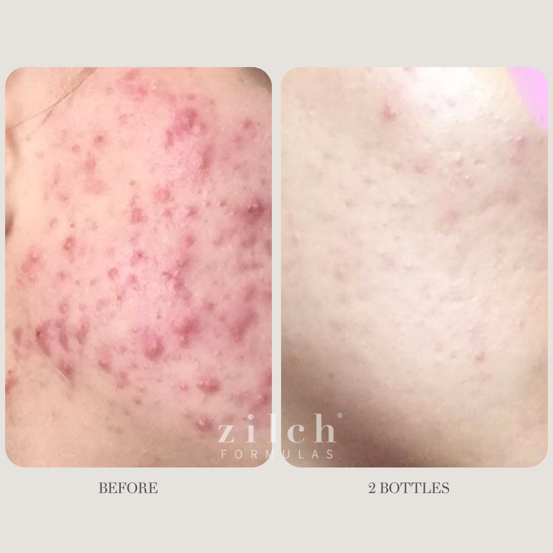 Zilch Acne Formula Before and After photo review