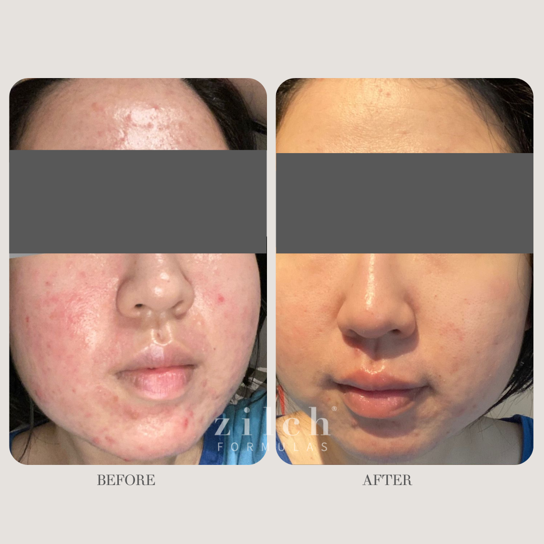 Zilch Acne Formula Before and After photo review 