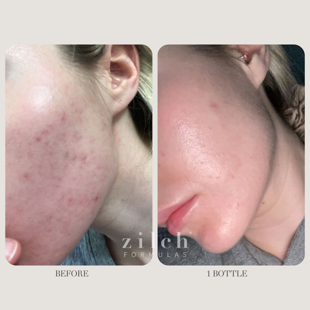 Zilch Acne Formula Before and After photo review 