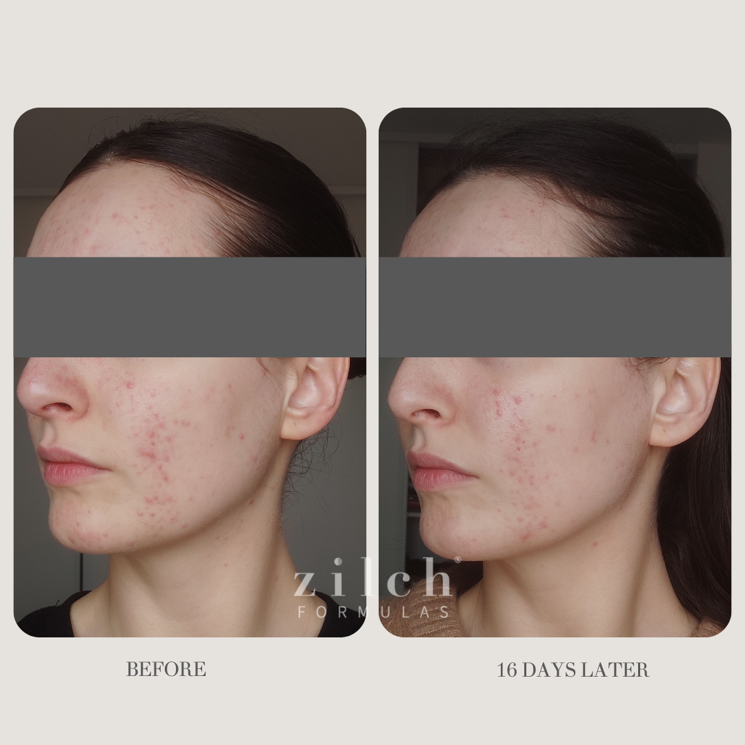 Zilch Acne Formula Before and After photo review