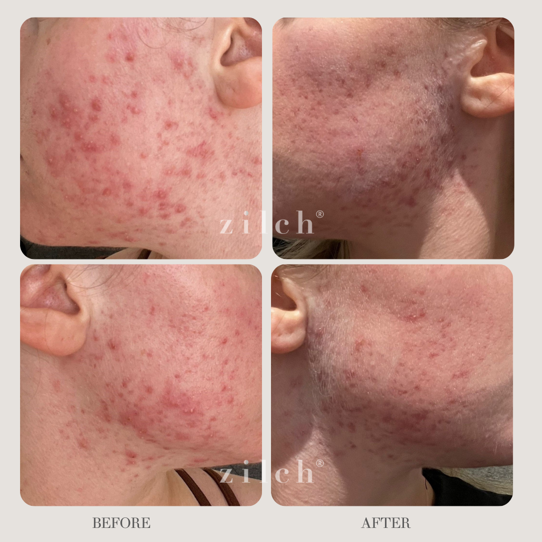 Zilch Acne Formula Before and After photo Review