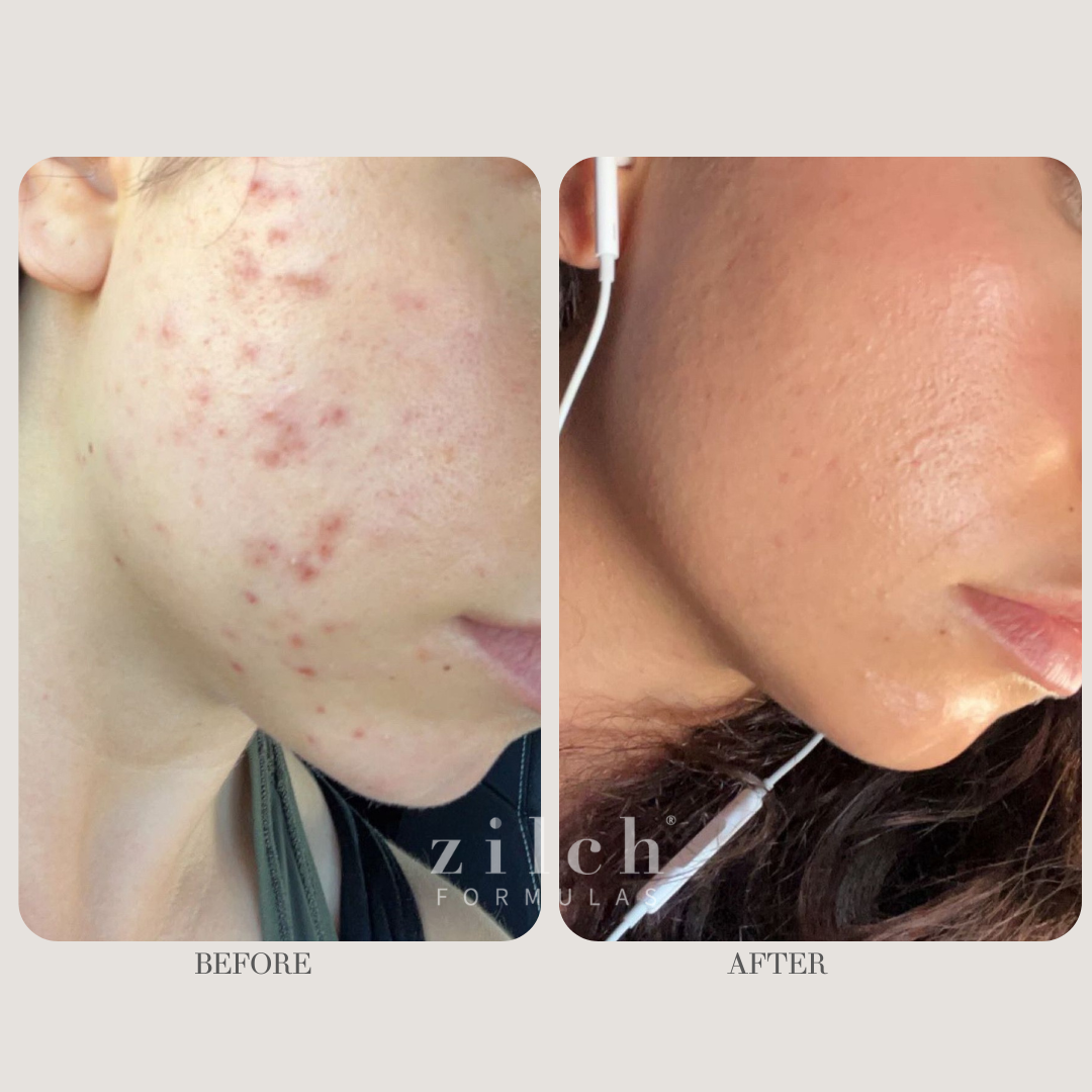 Zilch Acne Formula Before and After photo Review