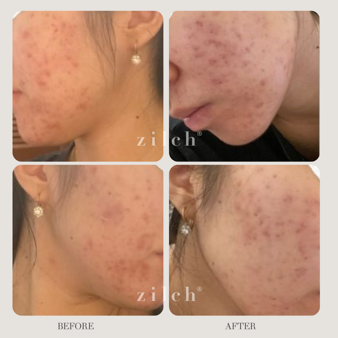 Zilch Acne Formula Before and After photo Review