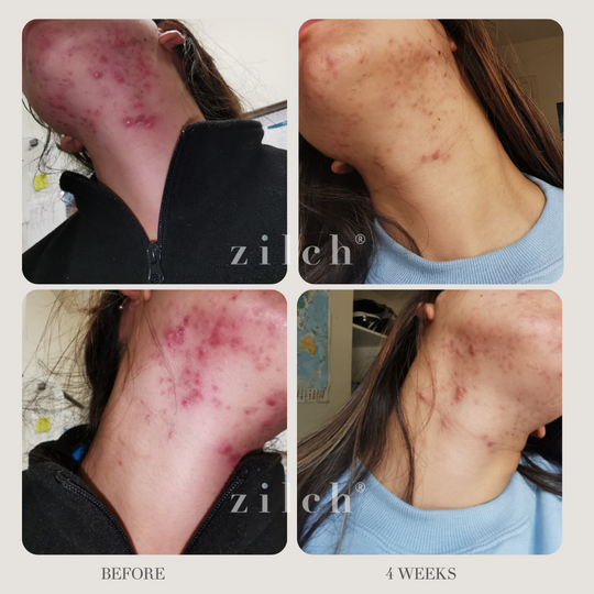 Zilch Acne Formula Before and After photo review 