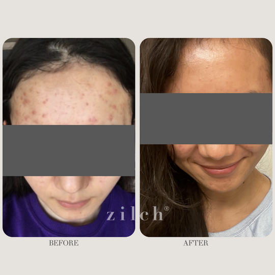 Zilch Acne Formula Before and After photo review